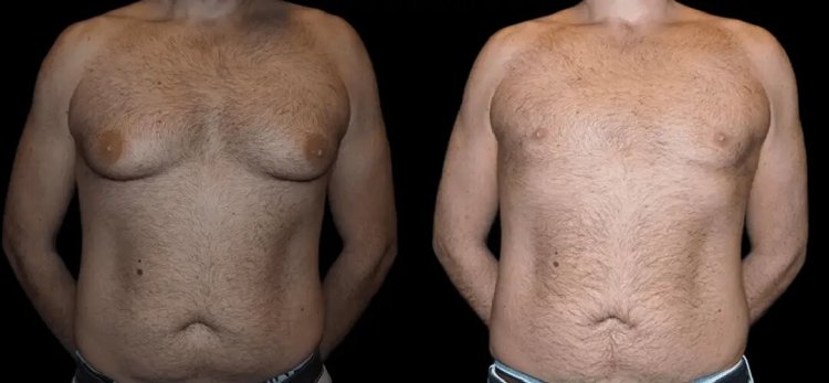 A Step-by-Step Guide to Gynecomastia in Dubai